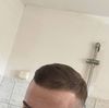 21M on Minoxidil 3 Months: Should I Add Finasteride for Thinning Hair?