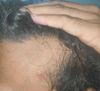 Early hair thinning + deficiencies — already on fin + topical min — should I add oral minoxidil? M 26