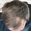33M, Increased Crown Thinning After Swapping Dut Only This Year