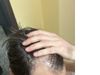Topical Treatment Progress