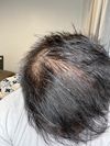 Hair Loss Worsened After 8 Months of 1.5mm Dermapen Use - Is It Permanent?