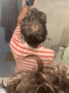 M33 Seeking Advice on Crown Hair Loss Treatments: Minoxidil vs. Finasteride vs. Transplant?