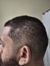 [GHK-Cu+AHK-Cu experiment] Stopping hair loss and promoting hair growth