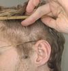 28M with Diffuse Thinning and Donor Area Affected, Dutasteride Not Working, Advice on Next Steps?