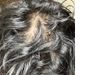 20M - Finasteride and Minoxidil for 1 Year Without Results, Considering Alternatives