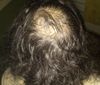 26M Seeking Advice on Crown Hair Regrowth After 5 Years of Neglect Due to Mental Health Issues