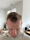 31M on TRT, 3 weeks into finasteride but getting dizziness — should I switch to topical, lower the dose, or consider a transplant?