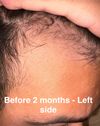 2-Month Progress on Hair Loss Treatment: Is It Working?