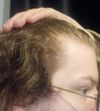 Seeking Advice on Potential Hair Recession Over 3-4 Months