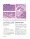 Lymphomatoid Papulosis Improving on Hormone-Replacement Therapy