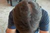 18M Diffuse Thinning on 1.5mg Oral Minoxidil, Avoiding Finasteride Due to Side Effects