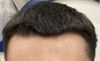 Experiencing Increased Hair Loss After 2 Months on Finasteride and 7 Months on Minoxidil
