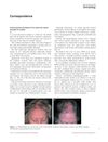 Erosive Pustular Dermatosis of the Scalp from Topical Minoxidil 5% Solution