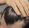 18 y/o – stable hairline with topical fin (Fynzur), Minoxidil &amp; Dermastamp – add oral Finasteride as prevention?