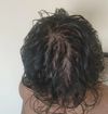 M24 Considering DHT Blocker vs Plasma After 2 Years on Minoxidil