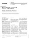 Alopecia Universalis Associated with Cutaneous T Cell Lymphoma
