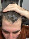 Seeking Advice on Dutasteride and Oral Minoxidil Effectiveness After 1 Year, Considering Finasteride