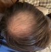 Dutasteride and Minoxidil User Considering Microneedling vs HT for Crown
