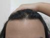 26M Considering &lsquo;Big 3&rsquo; or Dermatologist for Hair Thinning Advice