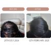 Topical Minoxidil 5% , Microneedling 1.25mm and Saw palmetto