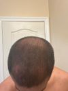 22M, Hair Loss Worsening Despite Microneedling and Supplements, Considering Minox/Fin