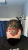 24M, Rejected from HT Clinics Despite 1.5 Years on Minoxidil/Finasteride, What Next?