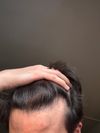 22M Seeking Alternatives to Finasteride to Maintain Hair Until Age 25