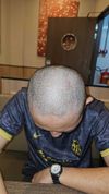 Should i do a hair transplant in my current state? Ive heard that HTs on diffuse thinners could kill existing follicles and be a net negative overall&hellip;Please help!