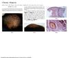 Chronic Alopecia: A Case of Trichotillomania in a 27-Year-Old Woman