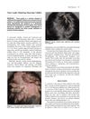 Tinea Capitis Mimicking Dissecting Cellulitis