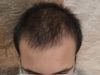 Hairloss journey from 18 years of age