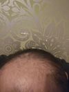 41/M Seeking Advice on Alternatives to Fin/Dut Due to Gyno