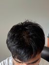 Hair Thinning Since Moving to Canada – Seeking Advice on Regrowth