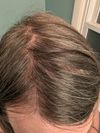 Considering Hair Transplant at 40 After Finasteride and Minoxidil