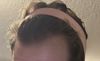 26M: Concerned About Minoxidil Dependency After Starting Treatment