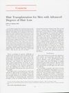 Hair Transplantation for Men with Advanced Degrees of Hair Loss
