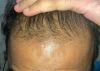 10 Months on Minoxidil + Finasteride, No Thickening in Frontal Region
