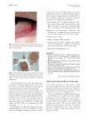 Alopecia-Associated Pseudocyst of the Scalp