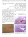 Delayed Onset Perforating Folliculitis Associated with Sorafenib