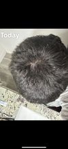 17M Concerned About Thinning on Back and Crown, Unable to See Dermatologist for a Year