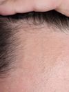 My hairloss recovery, March 2025-present