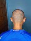 Advice for my hairloss situation