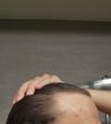 Scalp redness and in that spot having thinning hair?