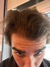 21M Seeking Advice for Top Hair Density After 1 Year on Finasteride, 2 Years on Minoxidil, and 3 Months Microneedling