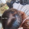 37 days on dut 0.5mg at 17 progress