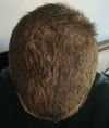 Minoxidl for a 17 year old boy?