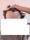 33M Considering Switch from Topical to Oral Finasteride for Temples and Crown