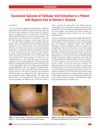 Successful Outcome of Follicular Unit Extraction in a Patient with Alopecia Due to Hansen’s Disease