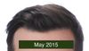 My hair loss accelerated after I (32M) turned 30