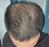 Seeking advice on increasing volume. Had transplant 5 years back for front hairline. On 1 mg fin